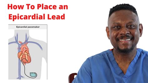 epicardial lv lead placement|what is an epicardial lead.